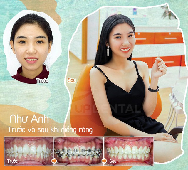 Trước và sau niềng răng - Sự khác biệt khó tin của những nụ cười - Ảnh 4.