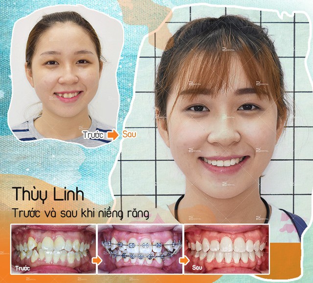 Trước và sau niềng răng - Sự khác biệt khó tin của những nụ cười - Ảnh 5.