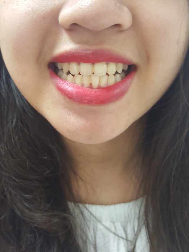Đang từ vàng cả hàm, răng cô gái này bỗng trở nên sáng lóa sau 1 tuần dùng sản phẩm trắng răng! - Ảnh 1.