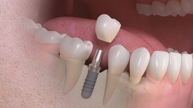 Trồng răng Implant – Giải pháp thẩm mỹ an toàn cho những người bị mất răng - Ảnh 1.