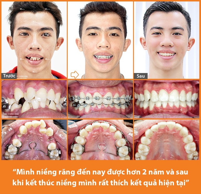 Nhật ký niềng răng 2 năm của chàng PT 24 tuổi tại nha khoa chuyên niềng răng Up Dental - Ảnh 2.
