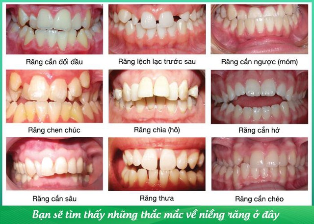 Suni Hạ Linh chia sẻ về quá trình niềng răng của bản thân tại buổi ra mắt sách - Ảnh 2.