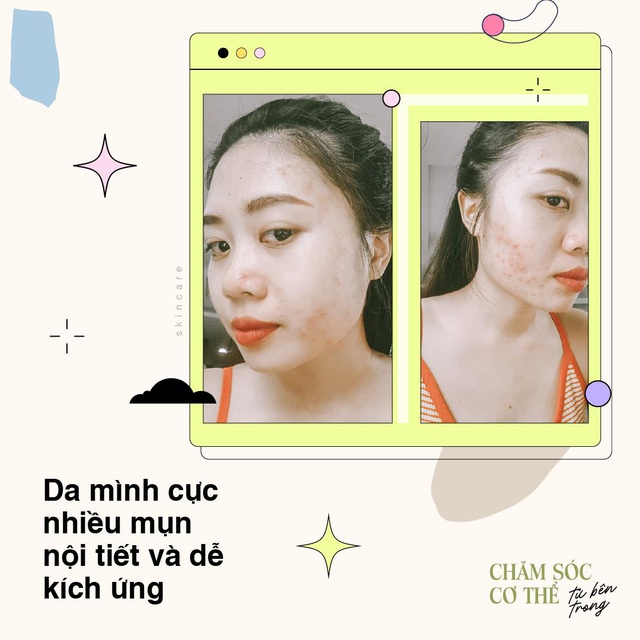 Từng phát khóc vì làn da mụn, gái xinh đã đổi cách chăm sóc da chuẩn, kết quả là giờ nhẵn mịn nhìn phát mê - Ảnh 3.