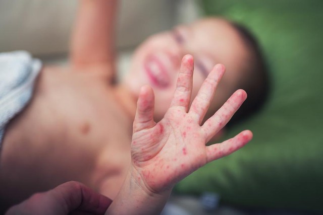 6 sai lầm khi chăm sóc trẻ bị tay chân miệng khiến bệnh càng nặng thêm, tiềm ẩn biến chứng nguy hiểm - Ảnh 3.