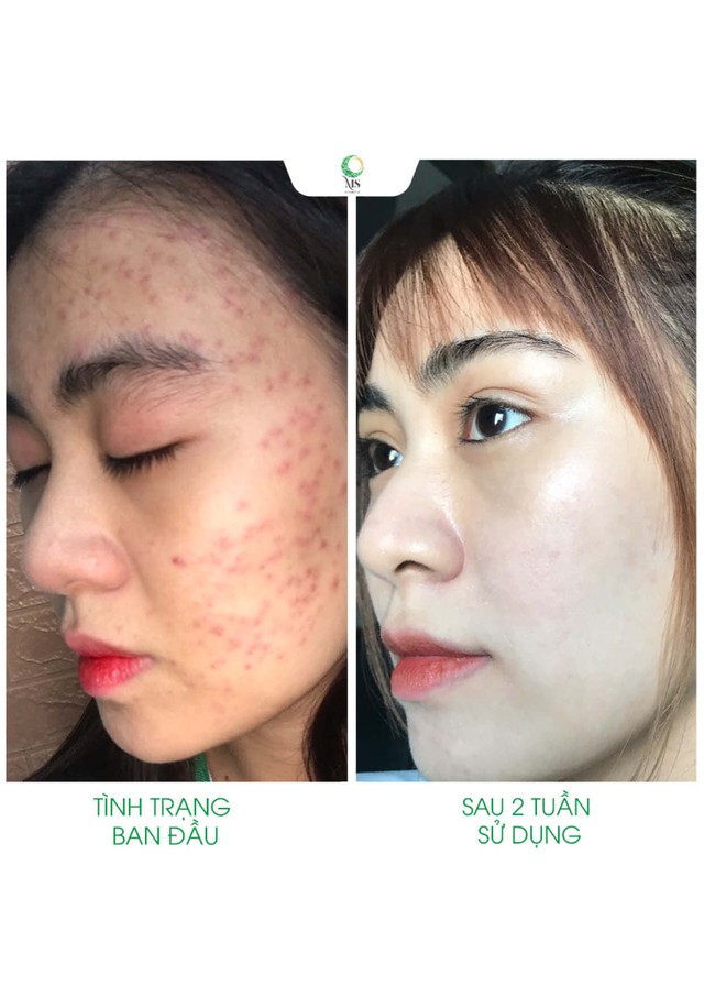 Thanh lăn mụn Ms Cosmetic giúp giảm các dấu hiệu mụn, thâm cứng đầu - Ảnh 2.