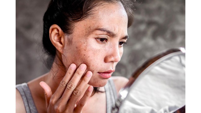 Da th&acirc;m sạm v&agrave; c&aacute;ch khắc phục dễ d&agrave;ng hiệu quả - Ảnh 1.