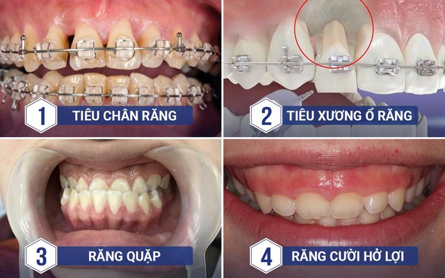 8 rủi ro tiềm ẩn khi niềng răng sai cách - Ảnh 1.