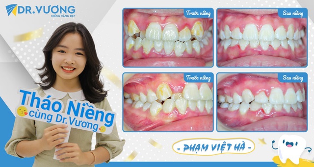 Cô bé “lãi” góc nghiêng vạn người mê nhờ niềng răng - Ảnh 3.