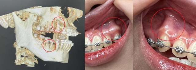 Niềng hỏng, tiền mất tật mang: Chuyện xui rủi đ&acirc;u ai muốn - Ảnh 1.