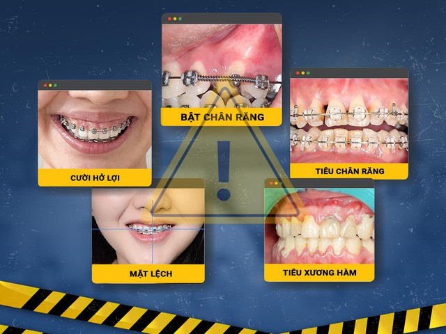 Niềng hỏng, tiền mất tật mang: Chuyện xui rủi đ&acirc;u ai muốn - Ảnh 3.