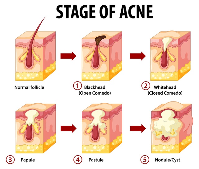 Bác sĩ Tô Lan Phương chia sẻ cách điều trị mụn trứng cá trong mùa nắng nóng - Ảnh 2.