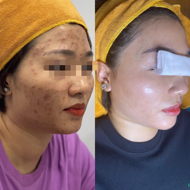 B&aacute;c sĩ Yến Nhi chia sẻ h&agrave;nh tr&igrave;nh gi&uacute;p h&agrave;ng trăm người điều trị mụn sẹo rỗ l&acirc;u năm - Ảnh 3.