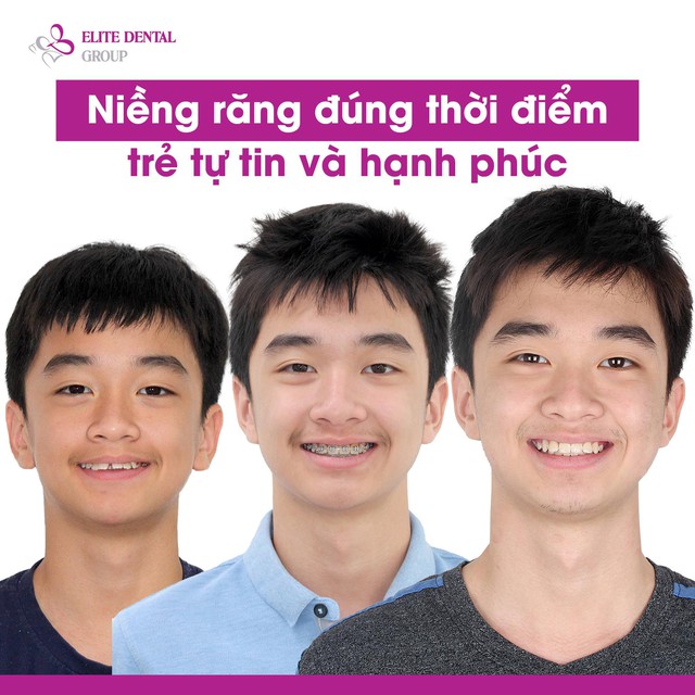 5 sai lầm thường gặp khi chỉnh nha v&agrave; lưu &yacute; để ph&ograve;ng tr&aacute;nh - Ảnh 3.