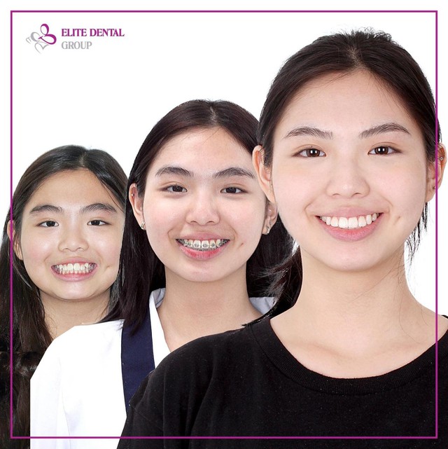 5 sai lầm thường gặp khi chỉnh nha v&agrave; lưu &yacute; để ph&ograve;ng tr&aacute;nh - Ảnh 4.