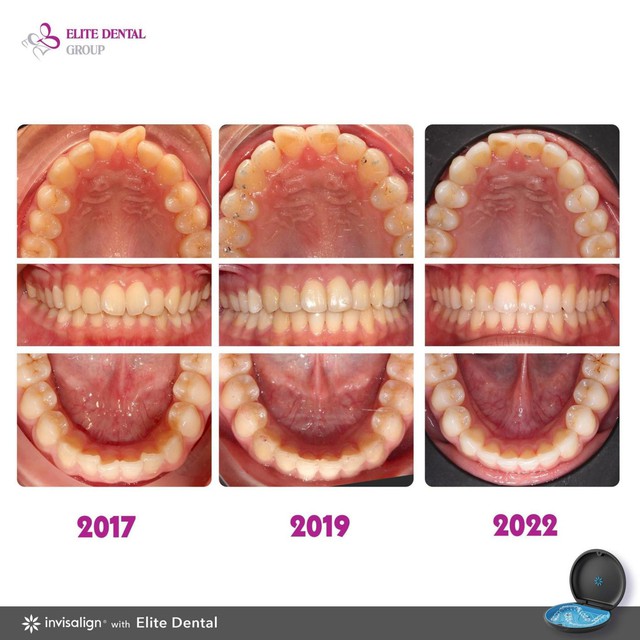5 sai lầm thường gặp khi chỉnh nha v&agrave; lưu &yacute; để ph&ograve;ng tr&aacute;nh - Ảnh 5.
