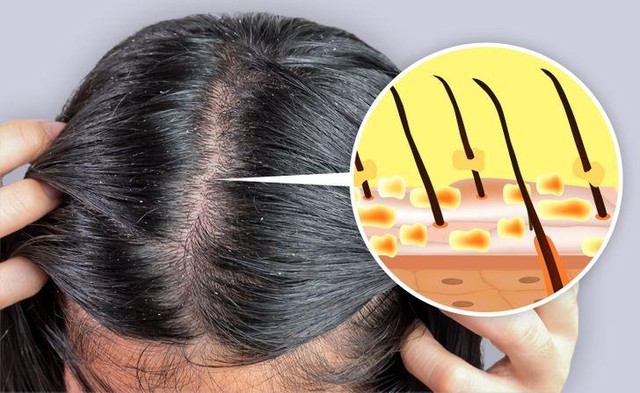 Ti&ecirc;u ch&iacute; chọn dầu gội trị g&agrave;u, ngứa da đầu hiệu quả - Ảnh 1.