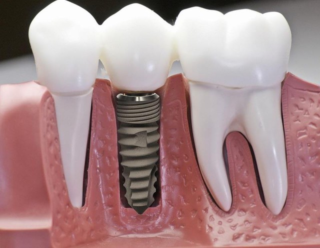 Lý do nên trồng răng Implant tại Nha Khoa SGC - Ảnh 1.
