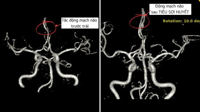 Cứu bệnh nhân đột quỵ thoát liệt người bằng phương pháp Tiêu sợi huyết - Ảnh 3.