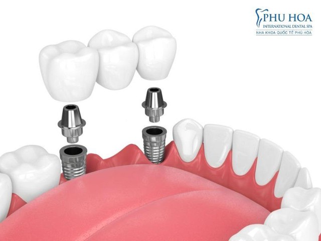 Công nghệ trồng răng implant vượt trội tại Nha khoa Quốc tế Phú Hòa - Ảnh 1.