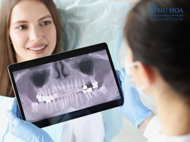 Công nghệ trồng răng implant vượt trội tại Nha khoa Quốc tế Phú Hòa - Ảnh 2.