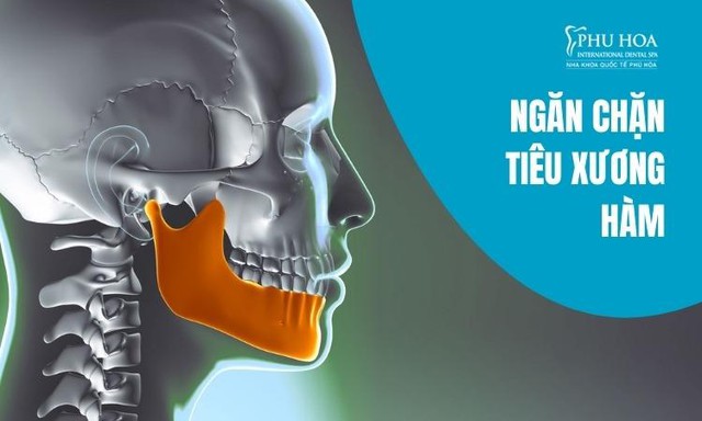 Công nghệ trồng răng implant vượt trội tại Nha khoa Quốc tế Phú Hòa - Ảnh 3.