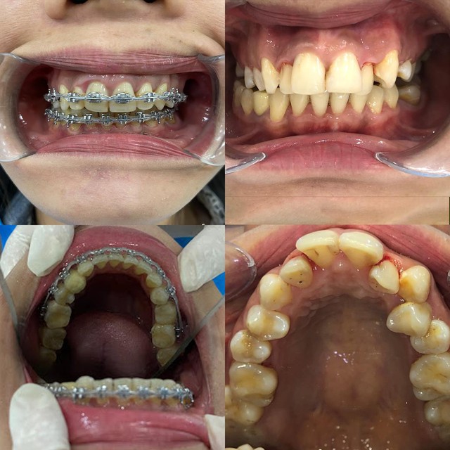 Nha khoa ST Dentist - Nơi niềng răng giá tốt cho Gen Z - Ảnh 1.