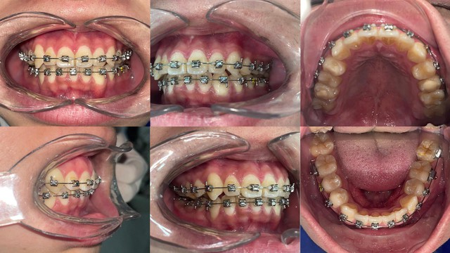 Nha khoa ST Dentist - Nơi niềng răng giá tốt cho Gen Z - Ảnh 2.