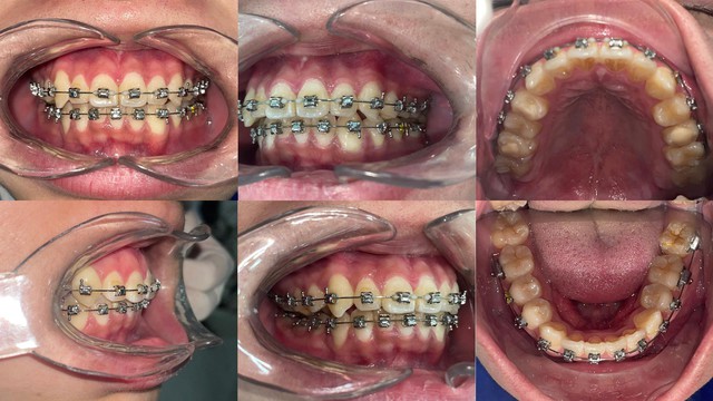 Nha khoa ST Dentist - Nơi niềng răng gi&aacute; tốt cho Gen Z - Ảnh 2.