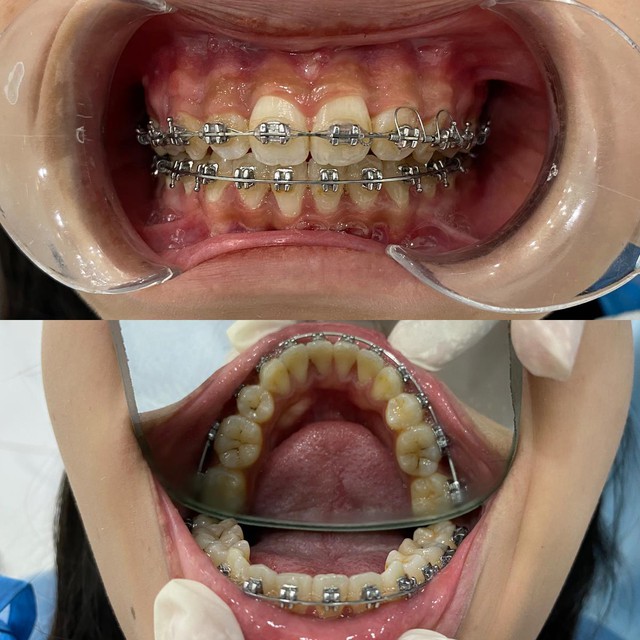 Nha khoa ST Dentist - Nơi niềng răng gi&aacute; tốt cho Gen Z - Ảnh 5.