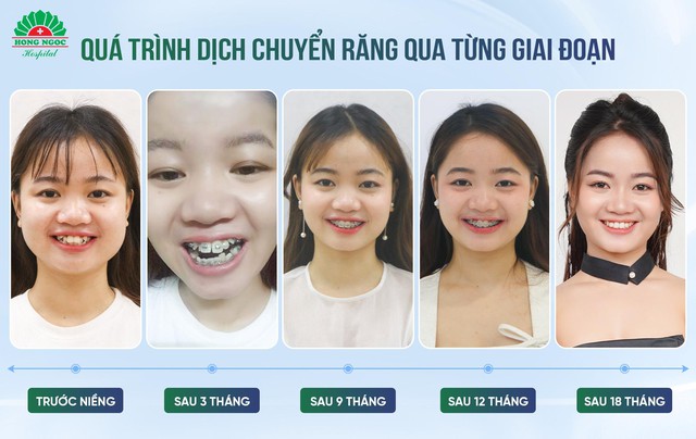 Niềng răng có thể thay đổi được gương mặt? - Ảnh 2.