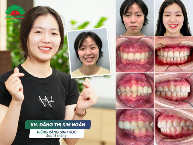 Niềng răng có thể thay đổi được gương mặt? - Ảnh 3.
