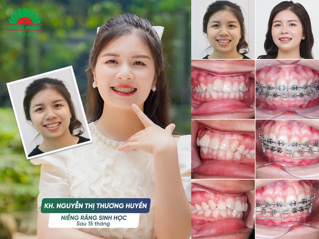 Niềng răng có thể thay đổi được gương mặt? - Ảnh 4.