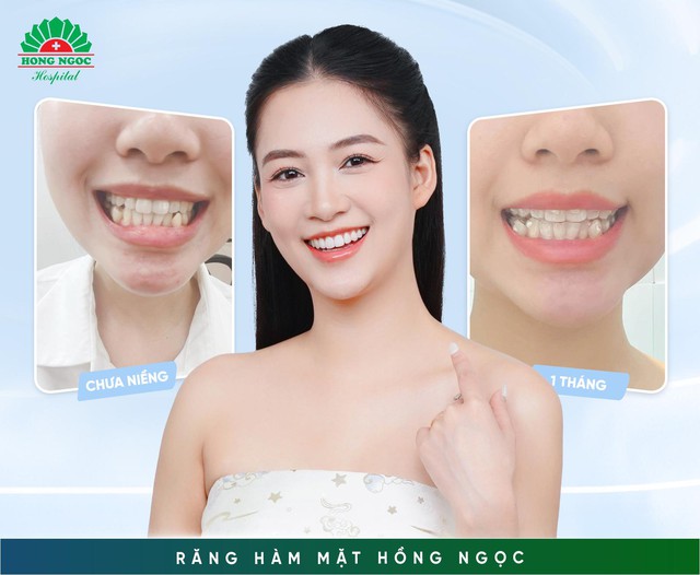 Niềng răng có thể thay đổi được gương mặt? - Ảnh 5.