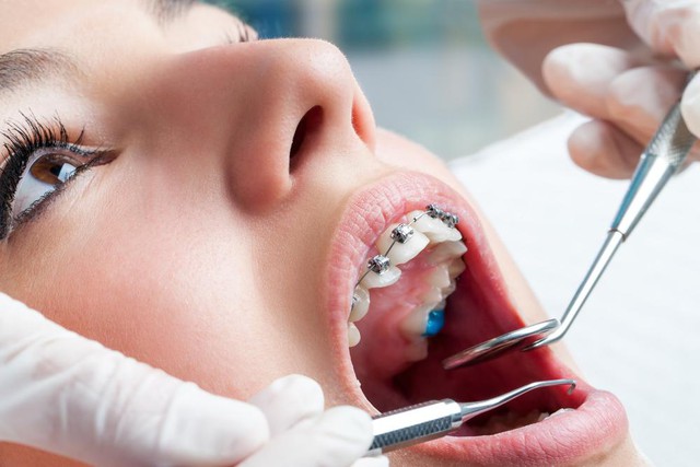 Niềng răng hỏng và những hệ lụy: Góc nhìn từ chuyên gia - Ảnh 1.
