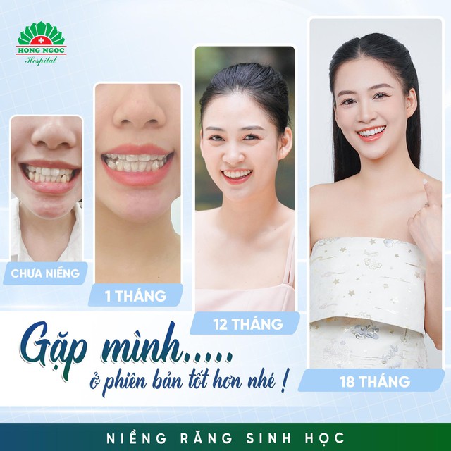 Niềng răng sinh học - Xu hướng chỉnh nha hiện đại - Ảnh 3.