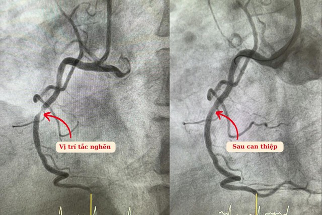 Điều trị hẹp nặng động mạch vành bằng kỹ thuật nong bóng phủ thuốc - Ảnh 1.