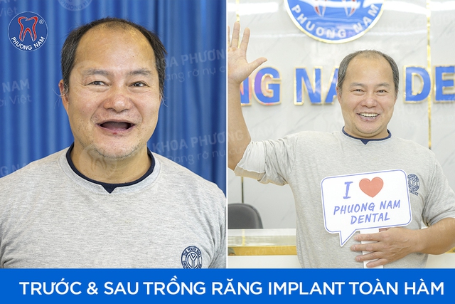 Bác sĩ Ngô Tùng Phương: Chuyên gia cấy ghép Implant hiệu quả cho người mất răng- Ảnh 1.