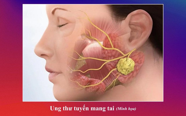 Những thách thức trong phẫu thuật khối u tuyến nước bọt mang tai- Ảnh 1.