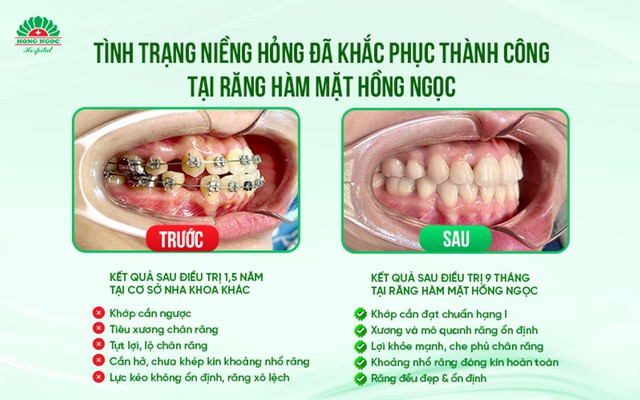 Từ ham rẻ đến hối hận: Khi chuẩn y khoa trở thành ranh giới giữa đẹp và biến chứng- Ảnh 2.