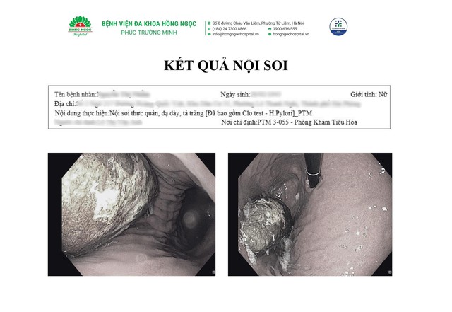 Nội soi lấy khối bã thức ăn "khổng lồ" 15cm trong dạ dày- Ảnh 1.
