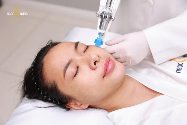 Laser se khít lỗ chân lông: Giải pháp cho làn da mịn màng tức thì- Ảnh 3.