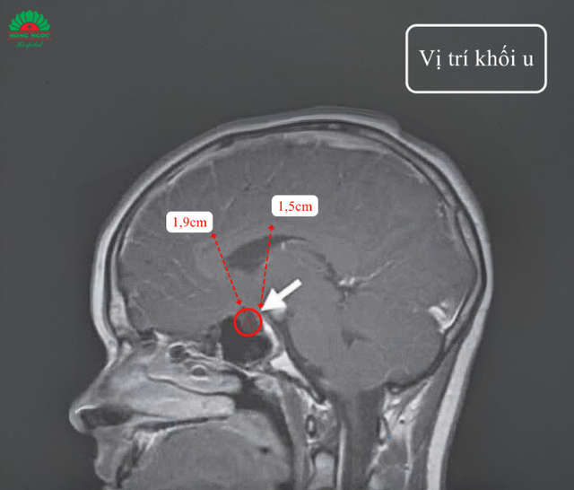 Tầm soát dậy thì sớm, bé gái bất ngờ phát hiện khối u não - Ảnh 2. Tầm soát dậy thì sớm, bé gái bất ngờ phát hiện khối u não - Ảnh 2.