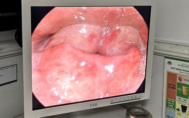 Cấp cứu phù nề thanh quản: Chậm vài phút bệnh nhân đối mặt nguy cơ mở khí quản- Ảnh 1.