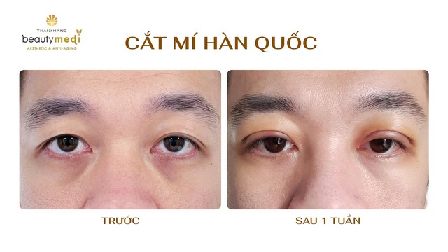 Đằng sau quyết định chỉnh mí là tầm nhìn lãnh đạo của nam doanh nhân- Ảnh 3.