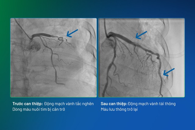BVĐK Phương Đông cứu sống bệnh nhân nhồi máu cơ tim cấp giữa “ma trận” bệnh lý phức tạp - Ảnh 1.
