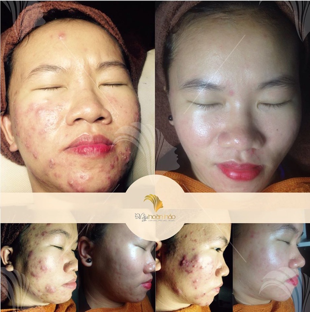 C&ugrave;ng ca sĩ Vicky Nhung truy t&igrave;m giải ph&aacute;p triệt ti&ecirc;u mụn, th&acirc;m, sẹo - Ảnh 2.