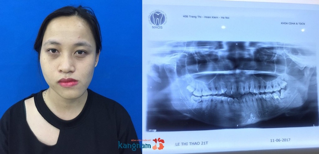 Đạt giải Hành trình lột xác 2017 nhưng Lê Thị Thảo vẫn không được phẫu thuật thẩm mỹ - Ảnh 1.