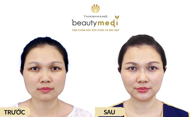 Tr&agrave;o lưu l&agrave;m đẹp kh&ocirc;ng dao k&eacute;o của giới trẻ - Ảnh 2.