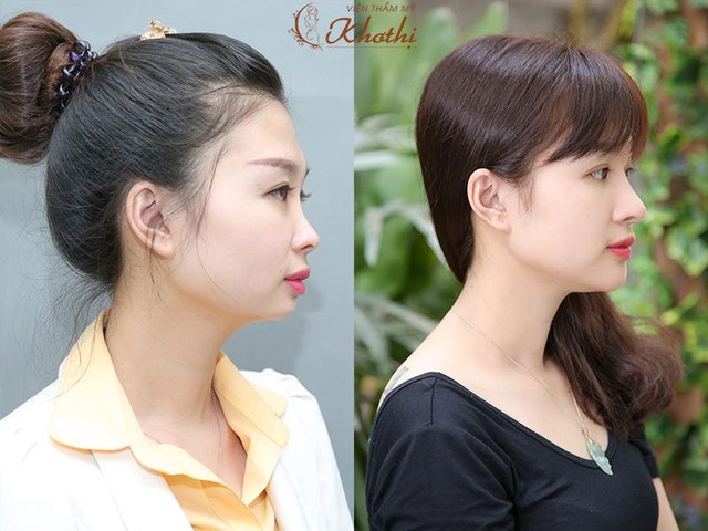 Những phương pháp thẩm mỹ không dao kéo sốt xình xịch trong năm 2017 - Ảnh 3. Những phương pháp thẩm mỹ không dao kéo sốt xình xịch trong năm 2017 - Ảnh 3.