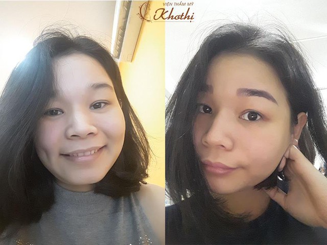 Những phương pháp thẩm mỹ không dao kéo sốt xình xịch trong năm 2017 - Ảnh 4. Những phương pháp thẩm mỹ không dao kéo sốt xình xịch trong năm 2017 - Ảnh 4.
